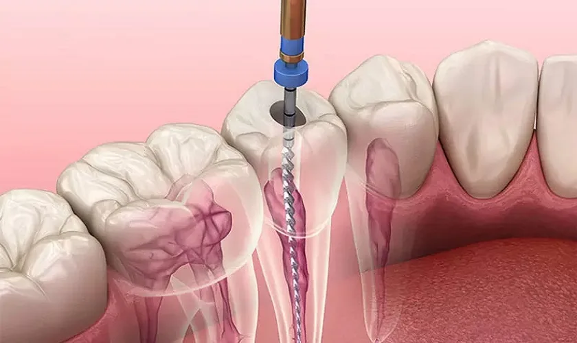 Quy Trình Điều Trị Tủy Răng Chuẩn Bộ Y Tế: Hướng Dẫn Đầy Đủ Từng Bước