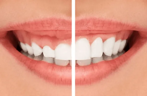 Răng ngắn: Nguyên nhân, Tướng Số, cách khắc phục