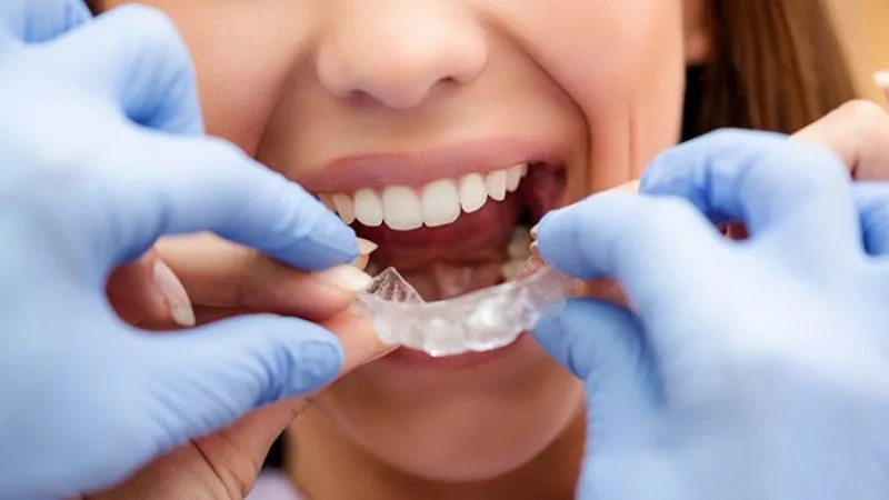 Cách dùng và tác dụng của máng chống nghiến răng khi ngủ
