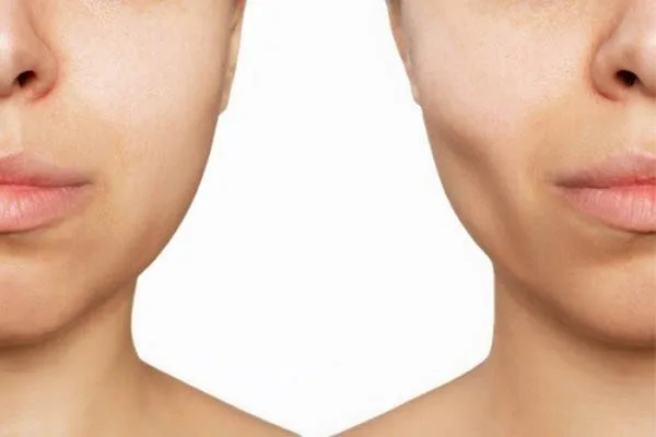 Bị mất răng hàm có bị hóp má không?