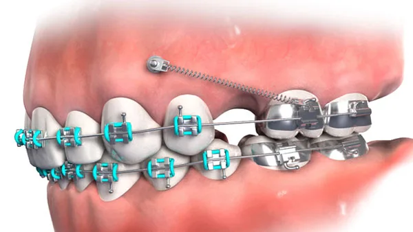 Tháo vít niềng răng có đau không? Tiêu chí tháo vít niềng răng