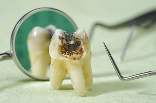 Răng số 7 bị sâu vỡ điều trị hết bao nhiêu tiền?