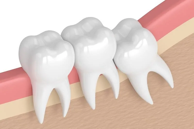 Chi Phí Nhổ Răng Mọc Lệch Ra Má Là Bao Nhiêu?