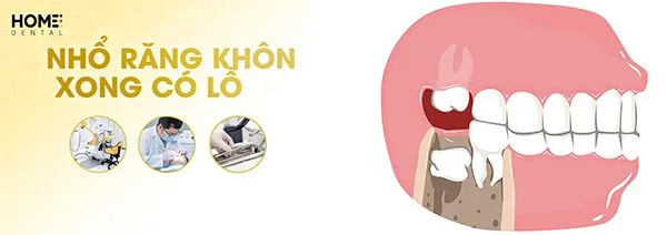 Tại sao nhổ răng khôn xong có lỗ? Cách chăm sóc đúng cách
