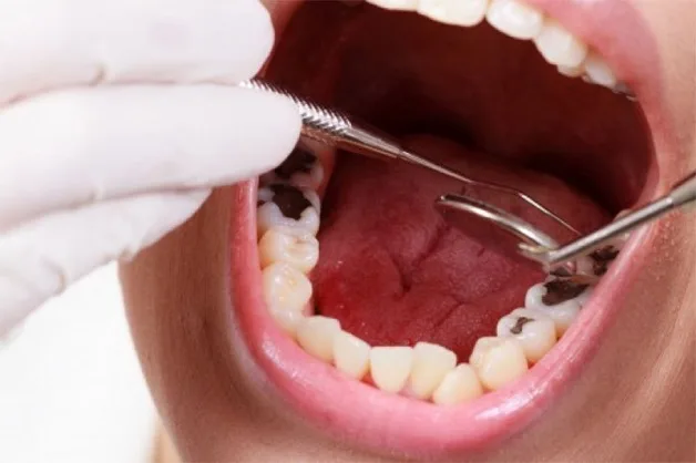 Nhổ răng xong ăn cay được không?