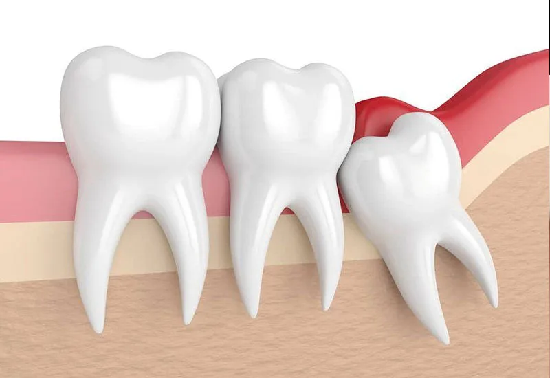 Nhổ răng khôn mấy ngày ăn được cơm?