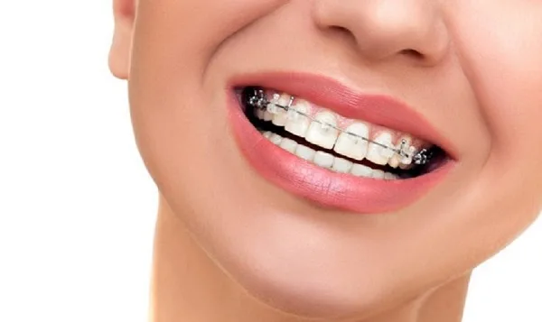 Niềng 1 răng có được không? Chi phí như thế nào?