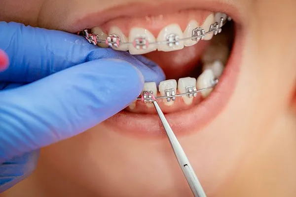 Niềng răng bị bật chân răng nguyên nhân do đâu?