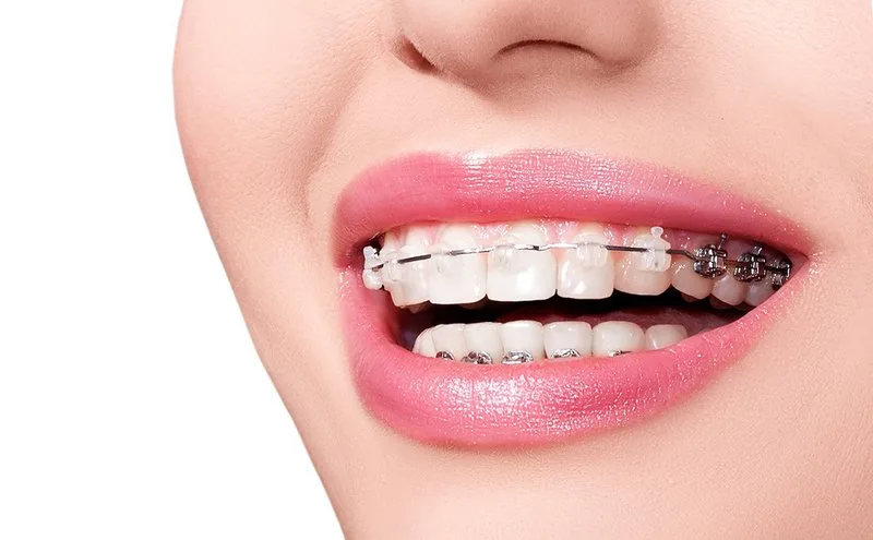 Tại sao phải niềng răng?