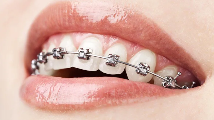 Niềng răng: Có nên nhổ 4 răng số 4? Hướng dẫn chi tiết & Lưu ý