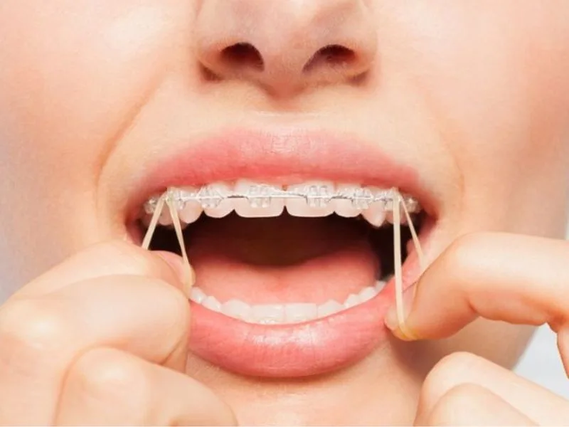 Nuốt thun liên hàm có sao không?