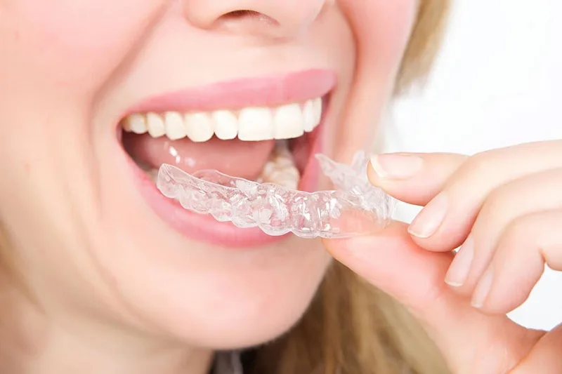 Niềng răng tháo lắp mức 1 là gì?