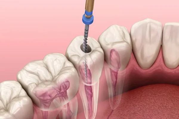 CHỮA TỦY RĂNG BỊ SÂU BAO NHIÊU TIỀN?