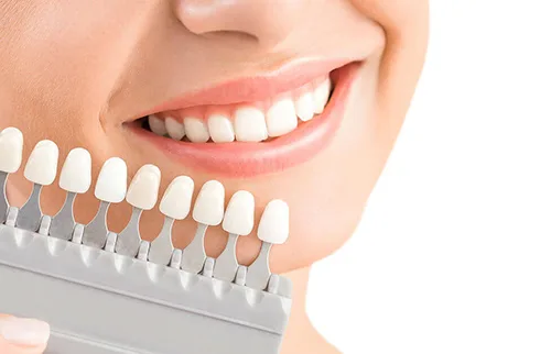 VÌ SAO SAU DÁN SỨ VENEER RĂNG DỄ BỊ SÂU RĂNG?
