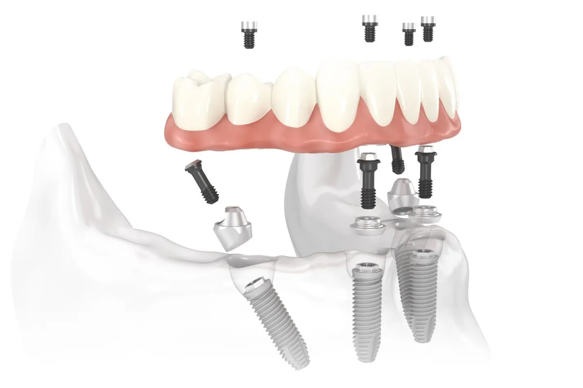 trong rang implant all on 4