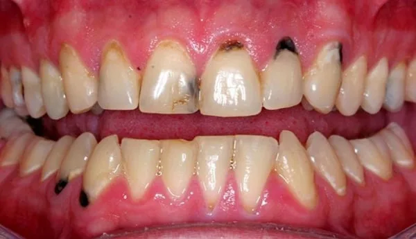 Cách điều trị răng bị đen ở kẽ&nbsp;