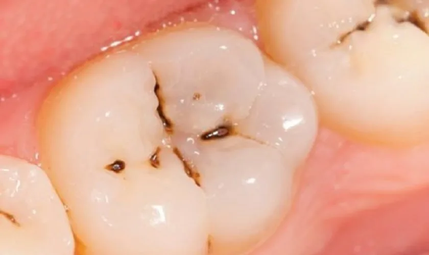 Răng Có Đốm Đen Là Gì? Nguyên Nhân và Cách Khắc Phục