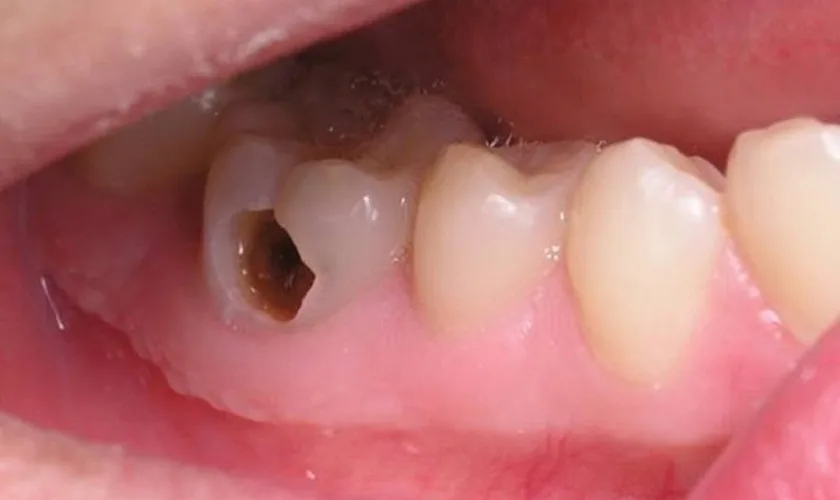 Vì sao răng hàm bị thủng lỗ to? Giải mã nguyên nhân & hướng điều trị hiệu quả