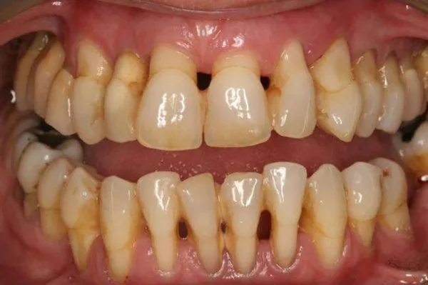 Mòn cổ chân răng có nguy hiểm không? Nguyên nhân và cách điều trị