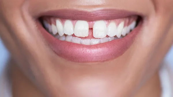 Một số cách khắc phục tình trạng răng cửa bị thưa