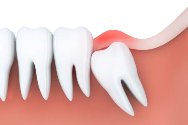 Tiết nhiều nước bọt sau khi nhổ răng khôn có sao không?