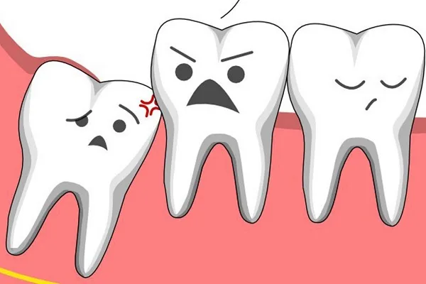 Những dấu hiệu nhiễm trùng sau khi nhổ răng khôn không nên bỏ qua