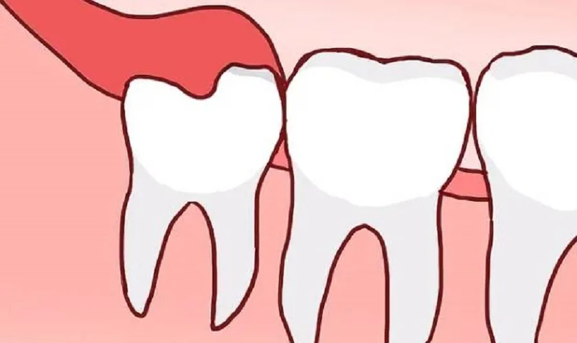 Tại sao răng khôn mọc thẳng vẫn đau?