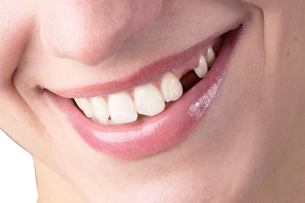 Nằm Mơ thấy rụng răng hàm trên không chảy máu: Điềm báo về tương lai