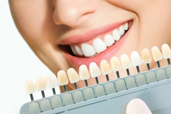 Các kinh nghiệm làm răng sứ thẩm mỹ nhất định phải biết