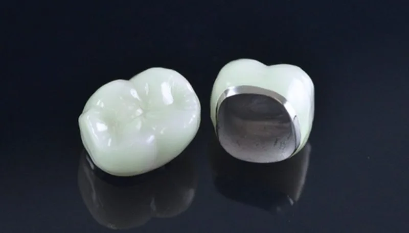 Khám Phá Răng Sứ Kim Loại Ni-Cr: Tất Tần Tật Những Điều Bạn Nên Biết