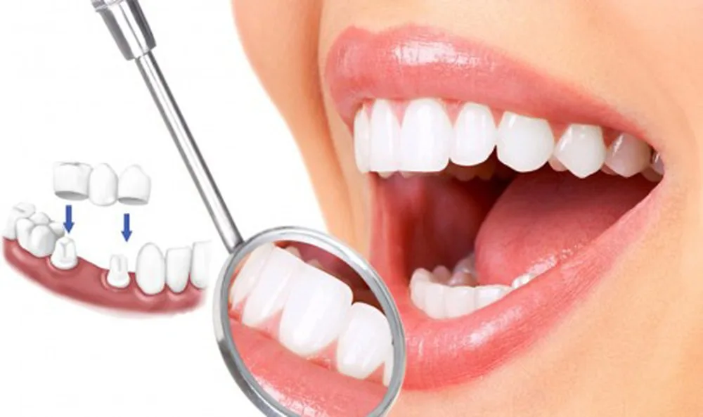 17 tuổi bọc răng sứ được không?
