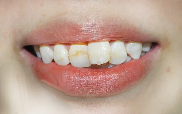 Niềng 1 răng có thực hiện được không? Chi phí sẽ như thế nào?