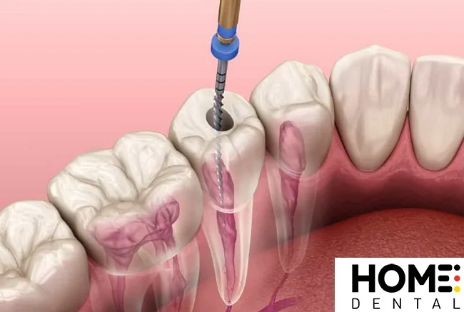 Cách chữa Tủy Răng Số 7: Quy Trình, Thời Gian, Chi Phí