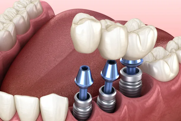 thuc hien dat tru implant All on 4 và All on 6