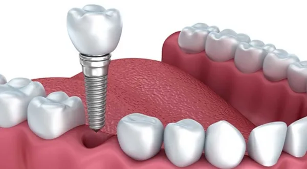 thuc hien dat tru implant