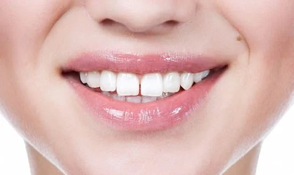 Trám răng cửa thưa bao nhiêu tiền