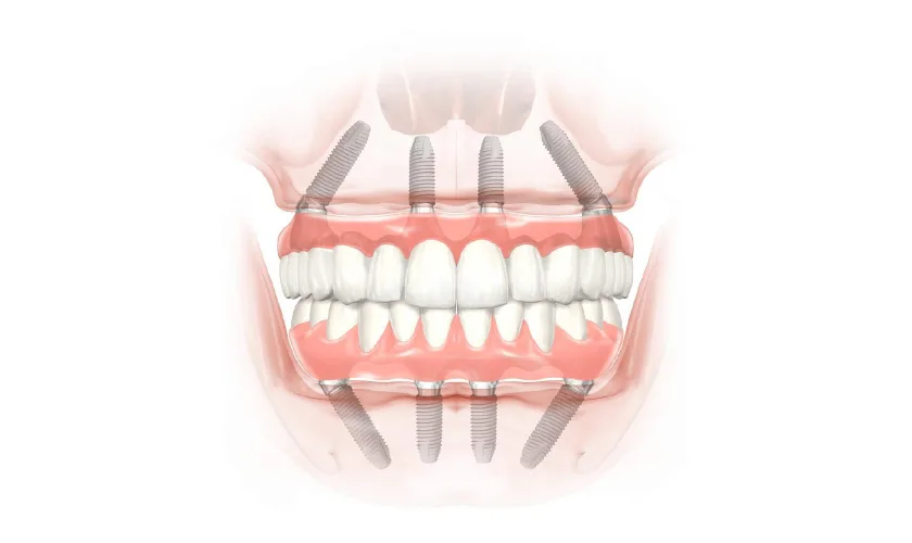 trong rang implant tuc thi