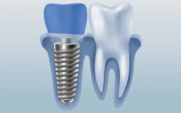 Trụ Implant Alphadent: Xuất xứ, cấu tạo và ưu điểm nổi bật