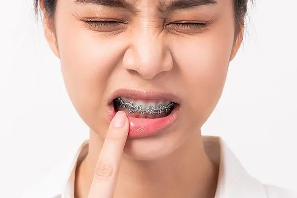 Tụt lợi dấu hiệu niềng răng hỏng