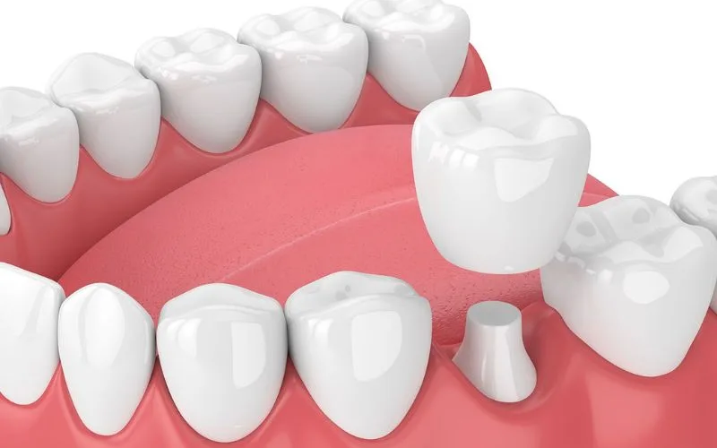 Răng sứ tháo ra có lắp lại được không?