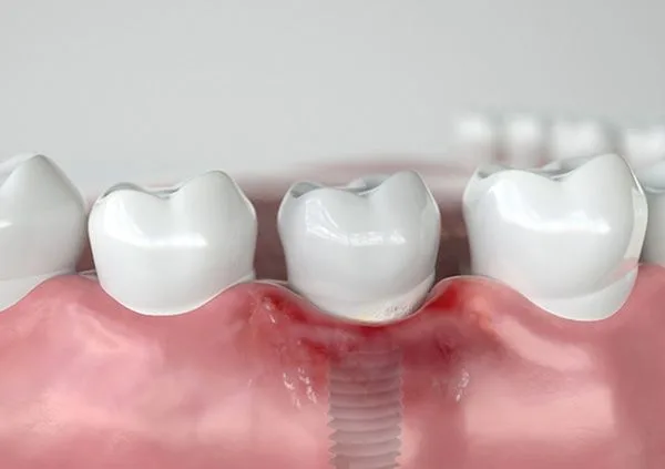 Viêm quanh răng implant: Triệu chứng và lưu ý khắc phục