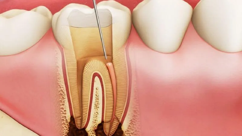 Viêm tủy răng để lâu có sao không?