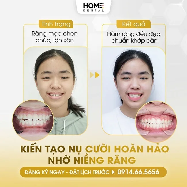 Sai khớp cắn có thể gây hỏng răng không? Tìm hiểu nguyên nhân và cách điều trị