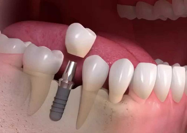 Cắm trụ răng Implant có đau không