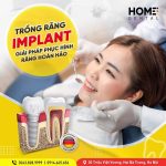 Giải đáp: Thời gian chế tạo răng Implant mất bao lâu?