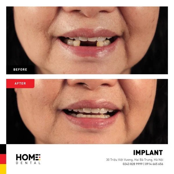 cấy ghép implant có ưu điểm gì