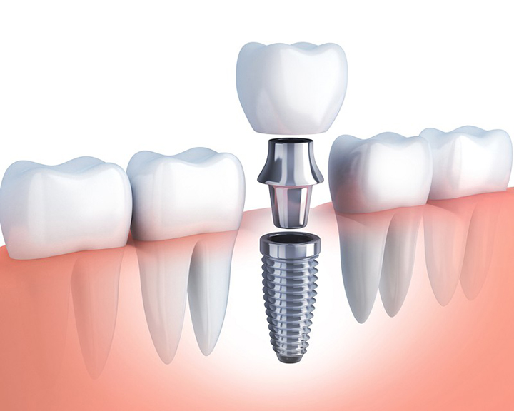 cam-ghep-rang-implant