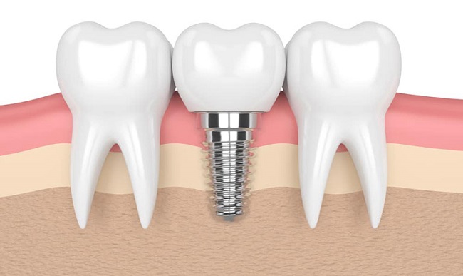 Các yếu tố có thể gây ra nguy hiểm khi trồng răng Implant