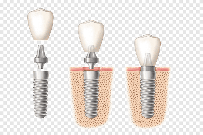 trụ implant