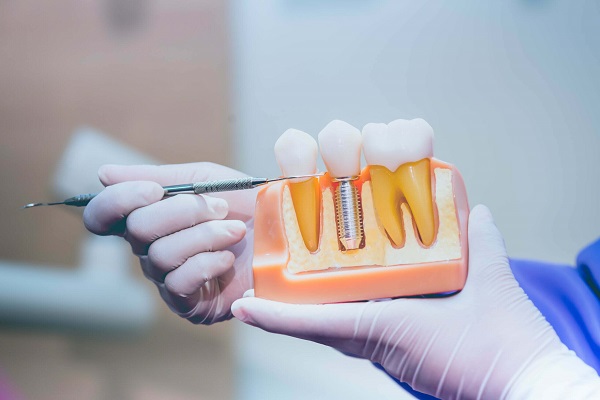 Niềng răng, Cấy ghép Implant có đi máy bay được không